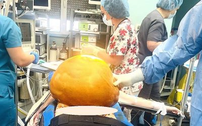 В „Александровска“ отстраниха тумор с тегло 27 кг.
